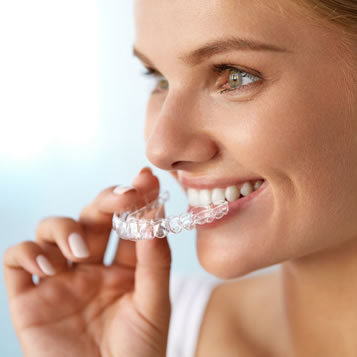 clear aligners